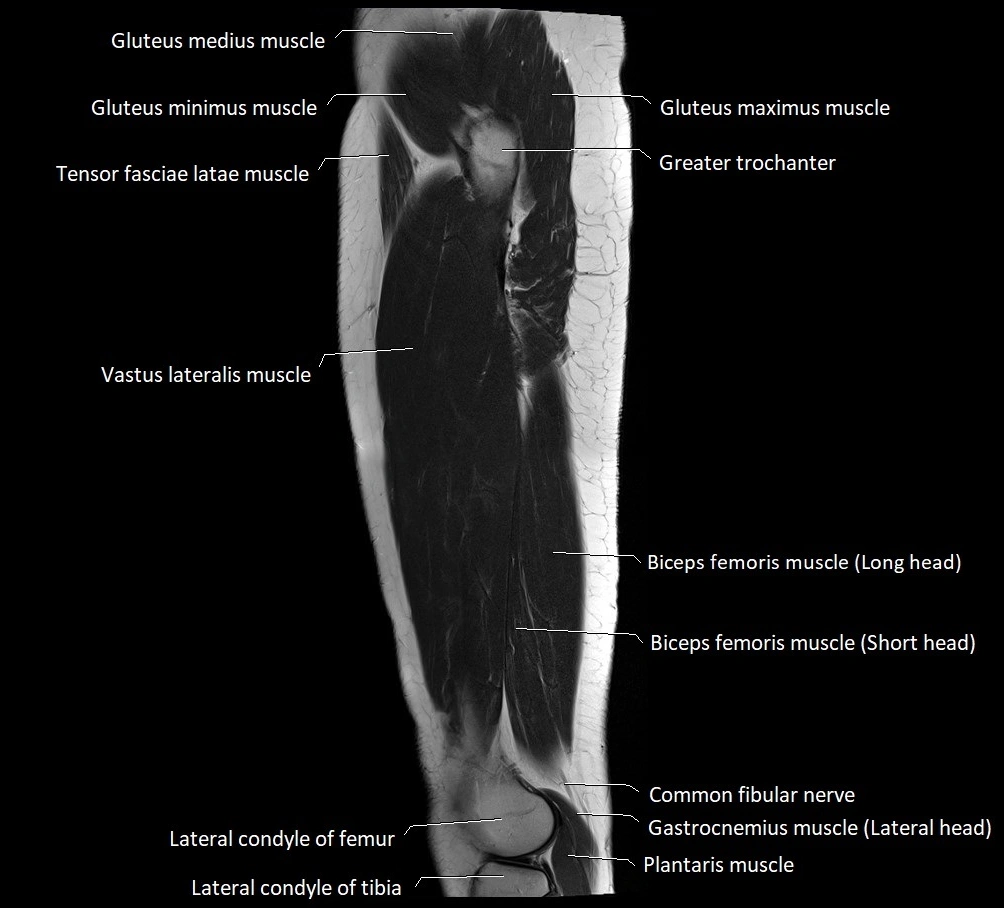Thigh sagittal cross sectional anatomy MRI 3T image 5.webp